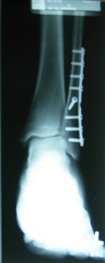 ankle.jpg